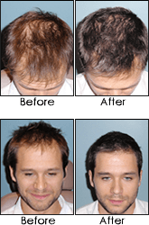 Hair Loss Treatment Before and After